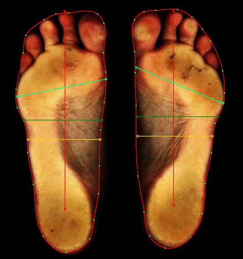 Fußscan Senk-Spreizfuß und Hallux rigidus