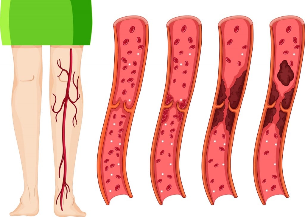 Illustration einer Vene bei einer Thrombose
