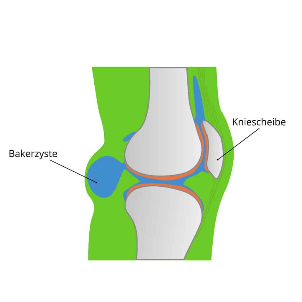 Illustration einer Bakerzyste