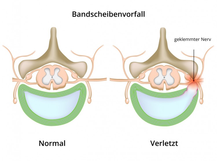 Bandscheibenvorfall FußschmerzenLexikon FußschmerzRatgeber