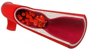 Blutgerinnsel in der Arterie