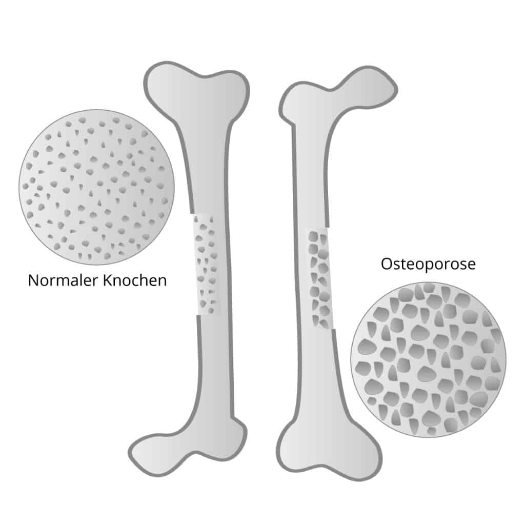 abnehmende Knochendichte bei Osteoporose