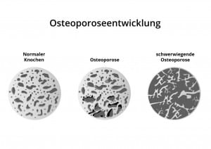 Darstellung Osteoporoseentwicklung