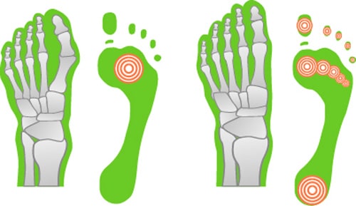 Darstellung der Druckpunkte eines Spreizfuß gegenüber eines normalen Fußes