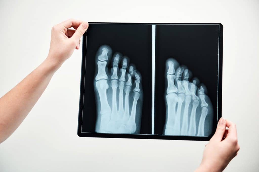 Person hält Röntgenbild von Füßen in die Kamera