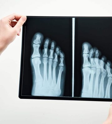 Person hält Röntgenbild von Füßen in die Kamera