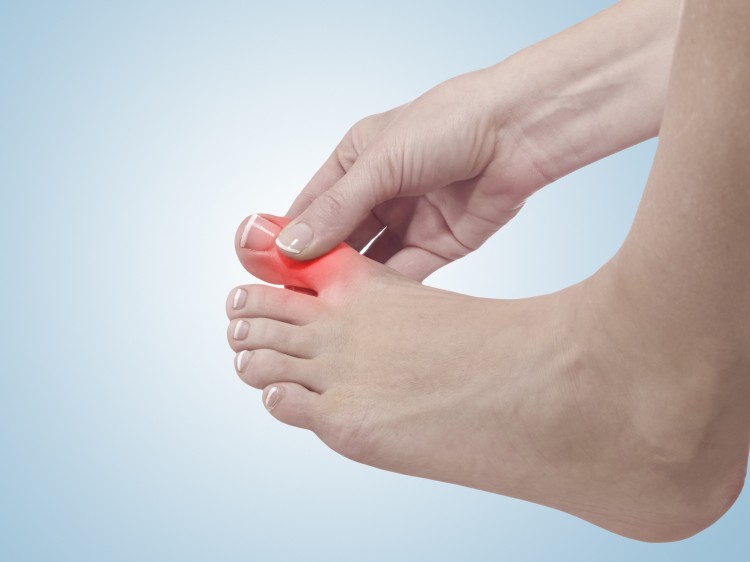 Fußschmerzen, die durch Hammerzehen entstehen, können durch das Tragen orthopädischer Einlagen gelindert werden.