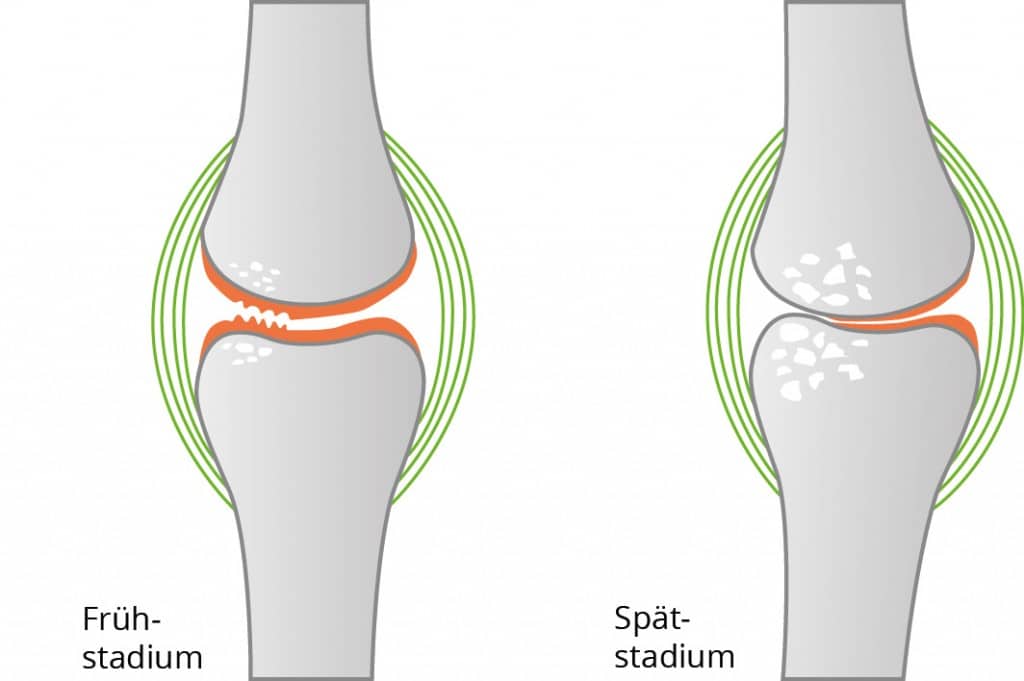 Illustration von Arthrose im Knie