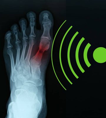 Niederenergetisch gepulster Ultraschall hilft gebrochenen Knochen beim Heilen