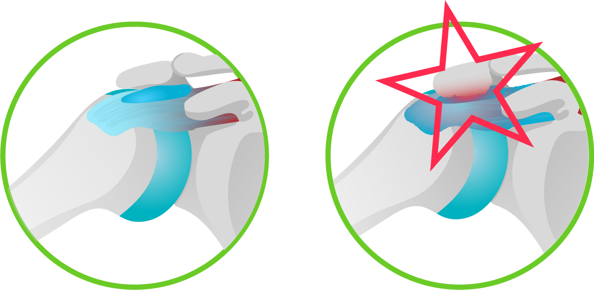 Schulterenge, Impingement